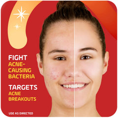 Asepxia control de brotes en áreas afectadas para piel más clara