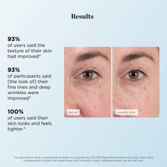Beverly Hills MD Deep Wrinkle Filler diamond dust detail for radiant, soft focus