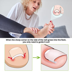 BEZOX straightener strip being applied to the toenail for gentle correction.