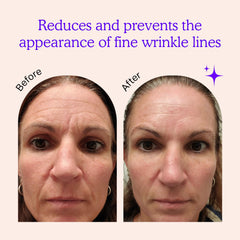 BLUMBODY forehead-wrinkles patch targeting brow lines overnight