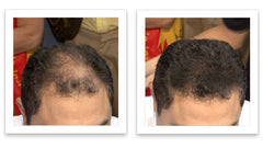 Caboki on thinning crown creates a denser appearance.
