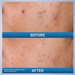 CeraVe Acne Control Gel frontal del frasco, ideal para uso nocturno