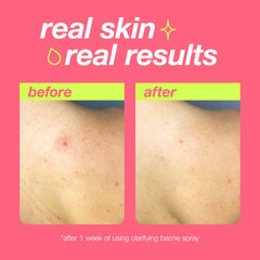 Dermalogica Clear Start Bacne Spray being sprayed from 12–18 inches away.