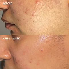 Dermisa barra exfoliante azufre aloe vera exfoliación suave