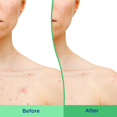 Differin exfoliante corporal glicolico 1% para reducir marcas.