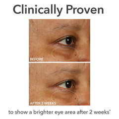 Under-eye area treated with DermInfusions for plump, refreshed appearance.
