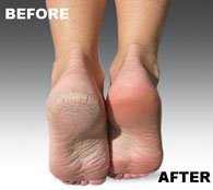 Emjoi Micro-Pedi blue roller during dry usage on feet