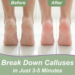 EntreFeet kit tackles dry skin near heels with care.