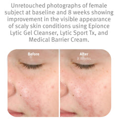 Dirt and oil dissolving action of Epionce Lytic Gel Cleanser on skin