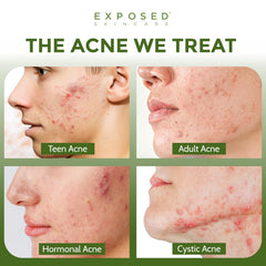 Exposed Skin Care Tónico: aplicación suave en la piel para calmar irritaciones.
