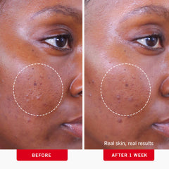 First Aid Beauty acne pads face suitable for cheeks and T-zone use.