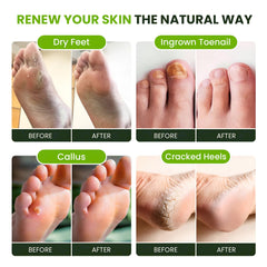 FOOT CURE Tea Tree Oil Foot Soak gentle on sensitive skin in a soak setup.