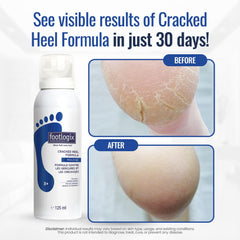 Footlogix dermal infusion technology close-up illustrating deep moisturization for cracked skin.