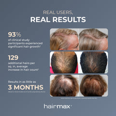 Hairmax Ultima 9 Classic in use on thinning scalp areas.