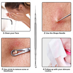 Jaxiria acne extractor round case image emphasizes portability and hygiene.
