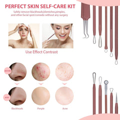 JPNK stainless steel pimple extractor with anti-slip grip for precise extraction.