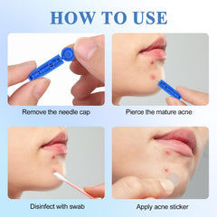 Lishae comedone removal tool ready for safe, controlled extraction.