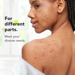 LitBear 12mm patch ideal for mid-size breakouts on cheeks or chin.