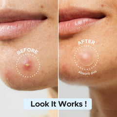 LitBear parche acne 12mm para granos grandes y visibles.