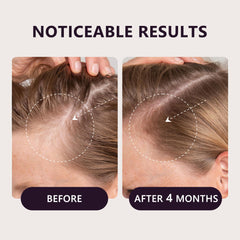 The LONGCCI 0.25mm derma roller is included for gentle scalp care.