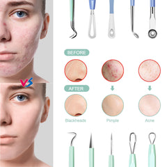 Menoly stainless steel pimple extractor demonstrates durable construction for hygienic use
