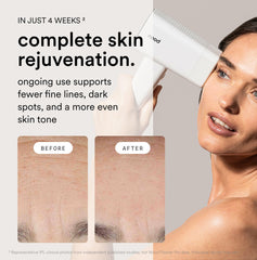 Nood Flasher Pro anti-aging lens for smoother-looking skin.