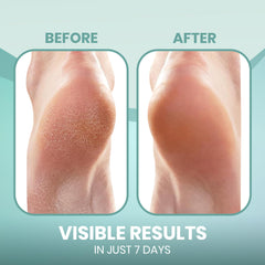 PhysFlex Moisturizing Socks worn overnight on foot for comfort