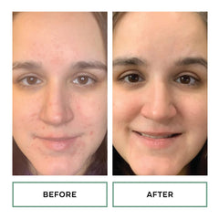 Gly-Sal pad used on face for cleansing and pore refinement.