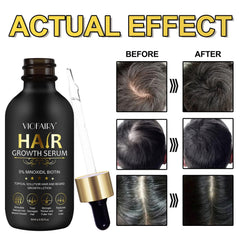 Aplicación diaria del suero minoxidil para estimular folículos capilares.