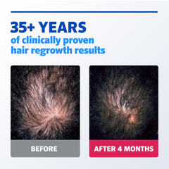 Rogaine Men’s Extra Strength 5% Minoxidil scalp application scene showing twice-daily use.