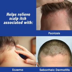 Scalpicin applying on scalp targets itching precisely.