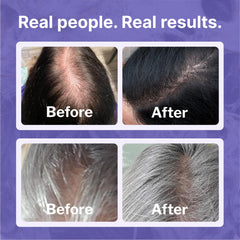 Shapiro MD Regrowth Kit Plus minoxidil dispense aids daily use.