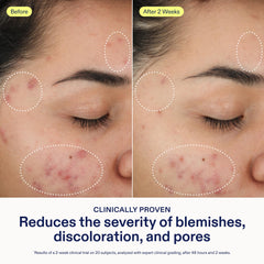 Skinfix 2% BHA Cleanser application on face to target oily areas.