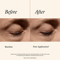 Dabbing SkinMedica eye cream on under-eye area for a refreshed look
