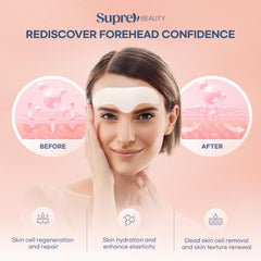 SupreH forehead wrinkle patches night-time application on forehead