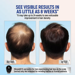 TARO Minoxidil foam on scalp application demonstrates precise scalp coverage