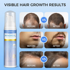 Trzsfr 5% Minoxidil foam on beard area for growth support