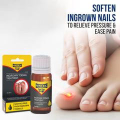 URIEL ingrown nail corrector tool in use highlights precise alignment for nail correction.