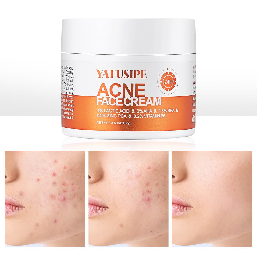 La crema YAFUSIPE Acne Frasco ayuda a limpiar poros y calmar la piel sensible.
