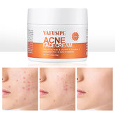 La crema YAFUSIPE Acne Frasco ayuda a limpiar poros y calmar la piel sensible.