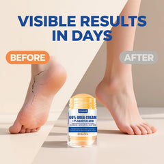 Elbow smoothing with ZyraGloz Urea Cream Stick showing rough-skin relief
