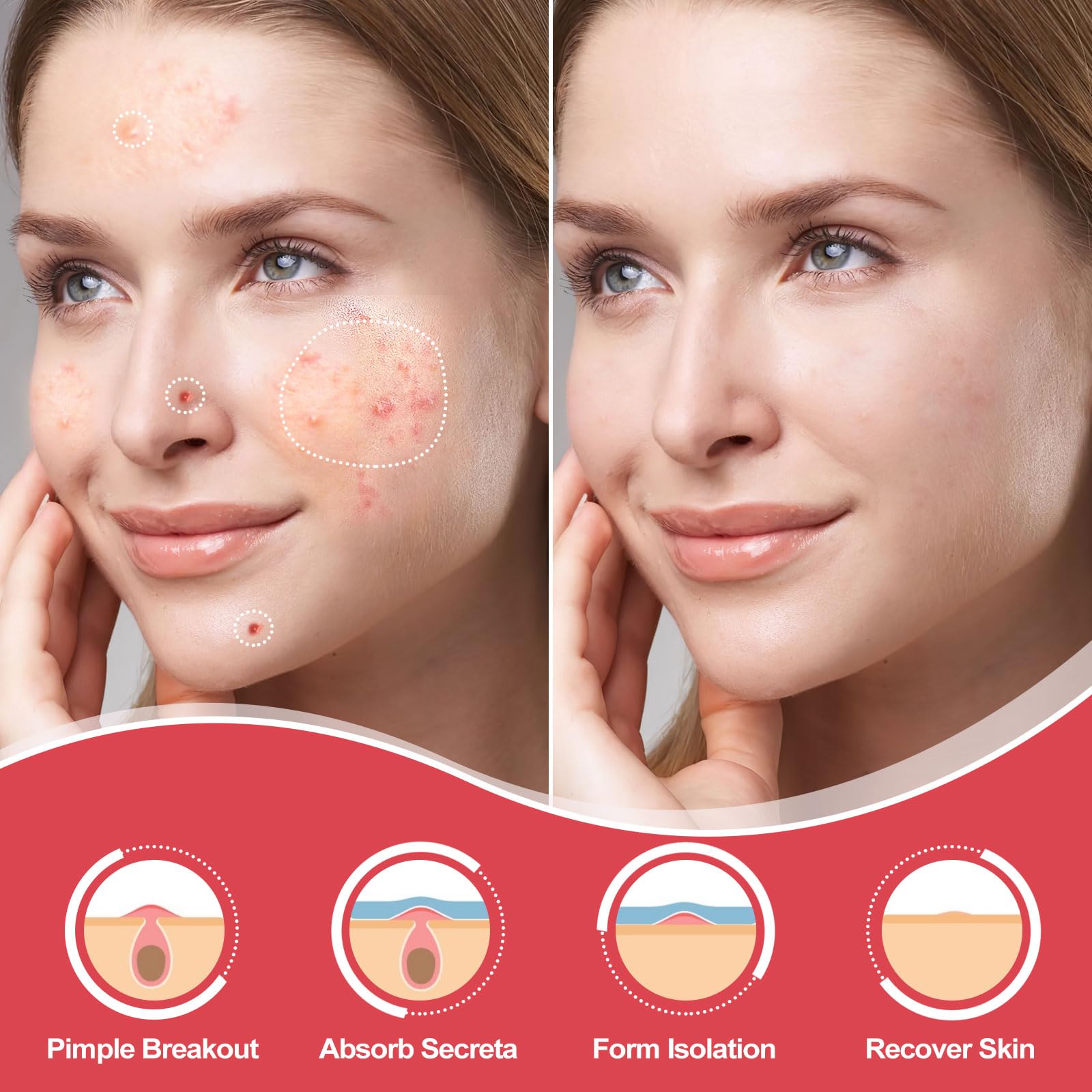 AcneGo skin-friendly hydrocolloid adhesion keeps patches secure overnight.