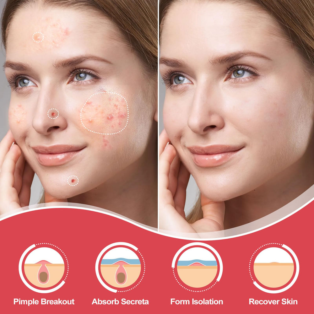 AcneGo skin-friendly hydrocolloid adhesion keeps patches secure overnight.