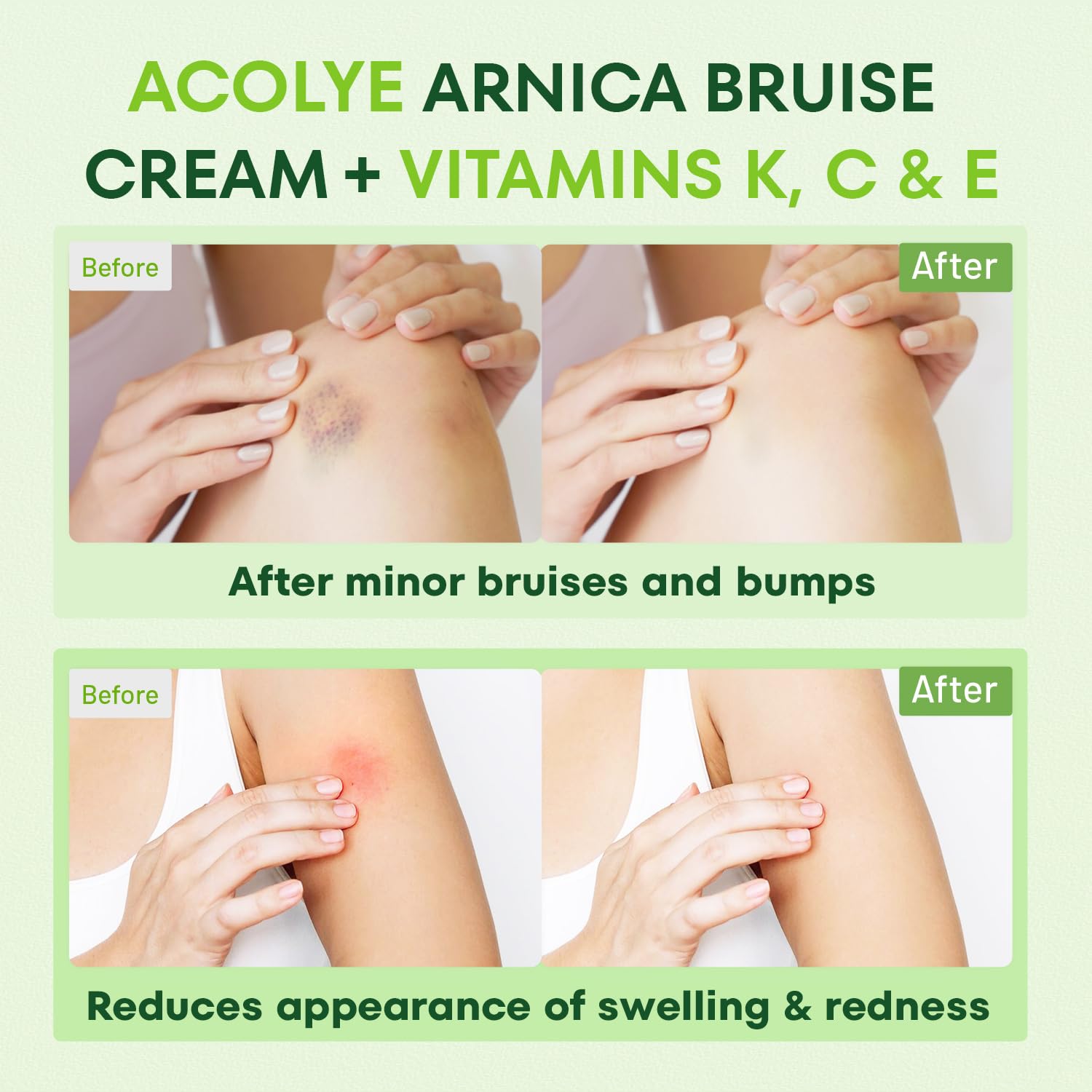 Crema Acolye Arnica con Centella Asiática para piel calmada y renovada.