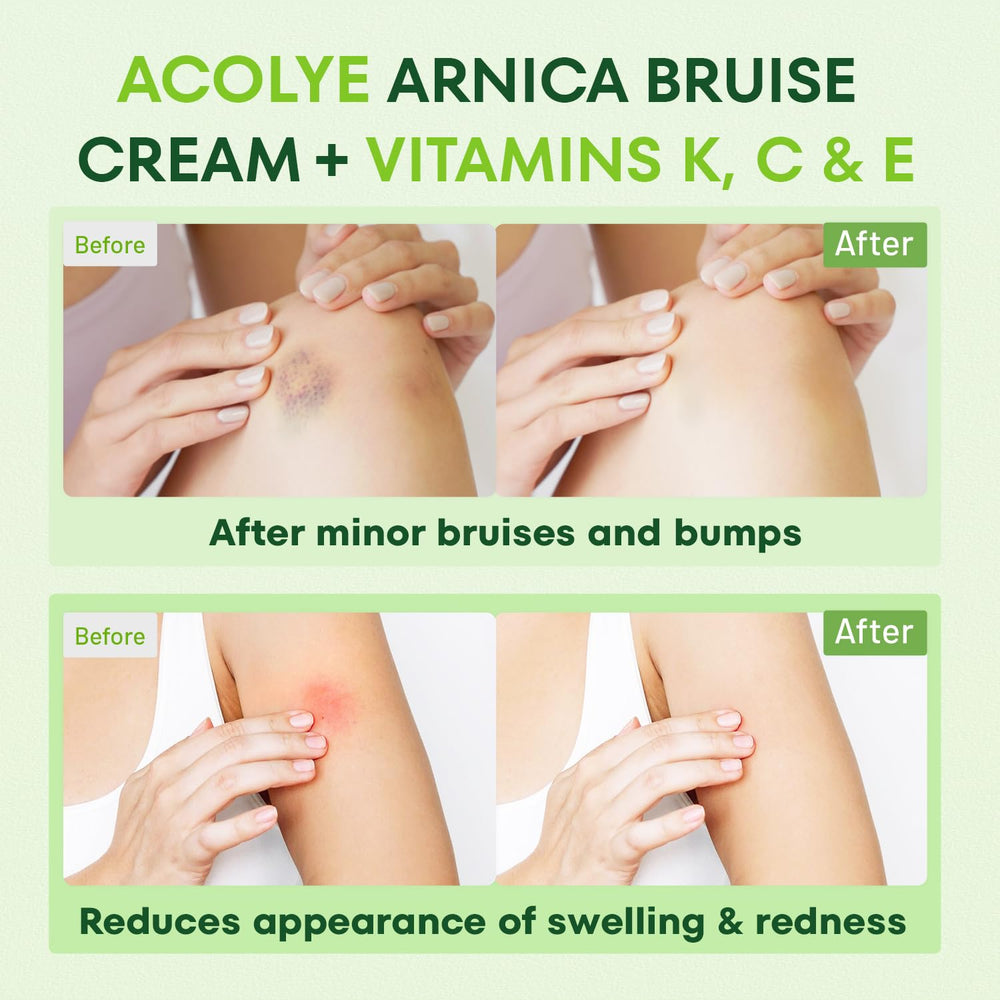 Crema Acolye Arnica con Centella Asiática para piel calmada y renovada.