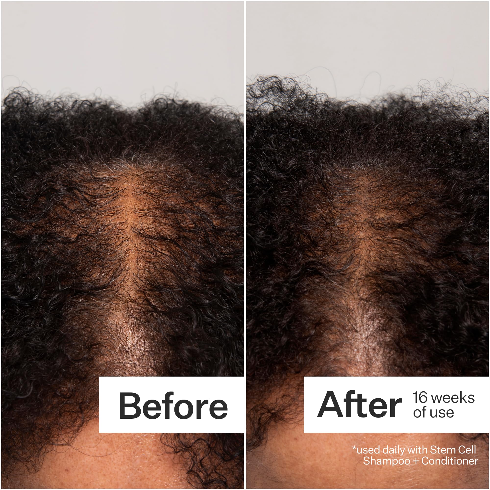 Gentle scalp massage aids absorption of ACT+ ACRE