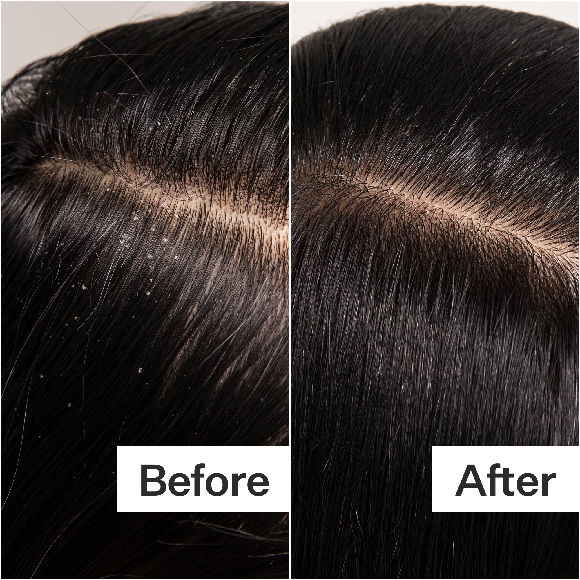 Actacre scalp with minimal buildup visual suggests thorough cleansing benefits.