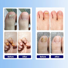 Aedydyce deep nail support patches applied to damaged nails