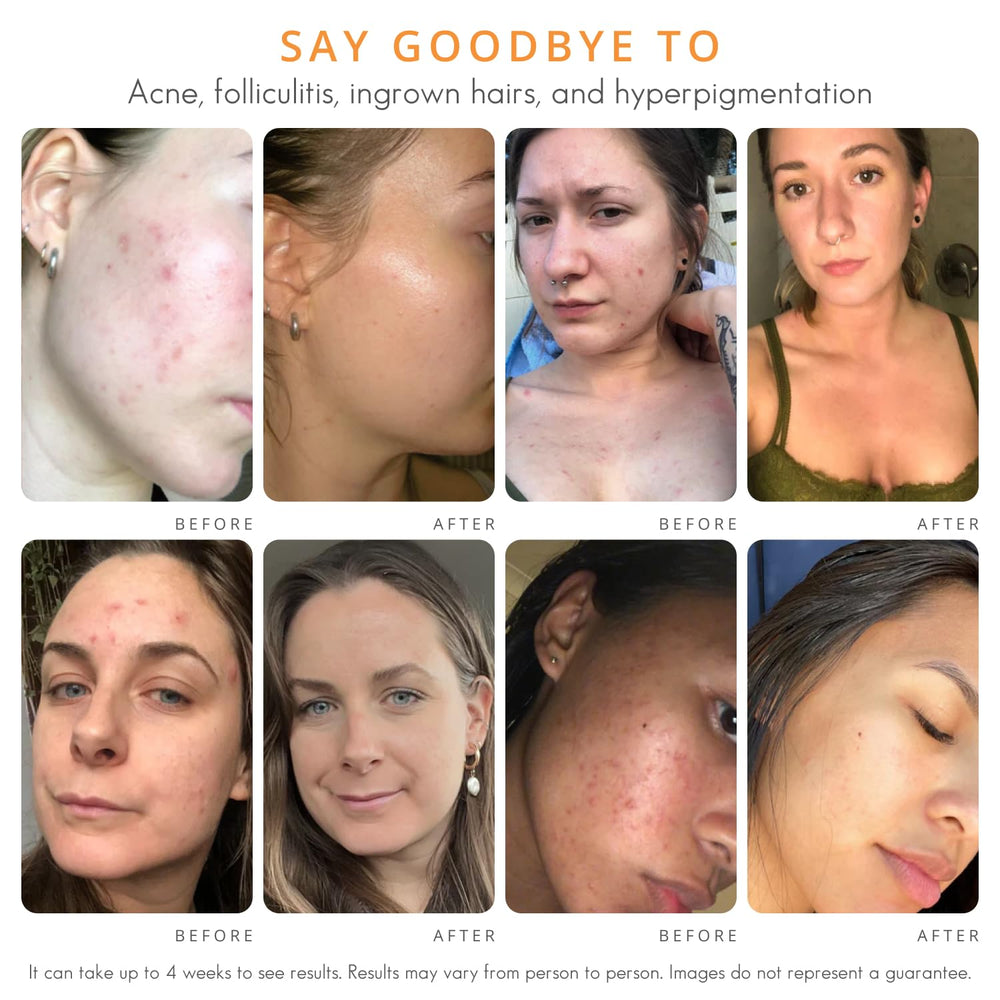 Almond Clear body application areas on chest and back