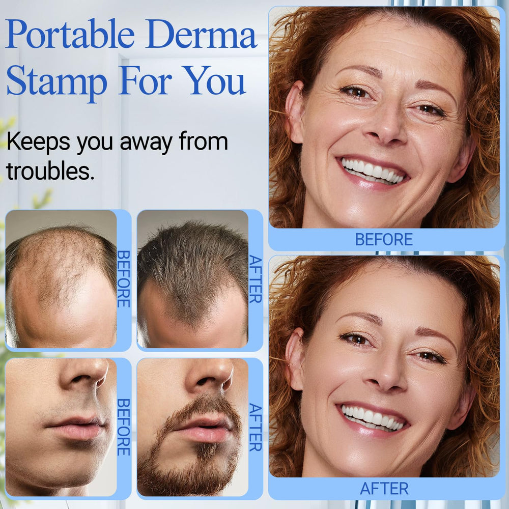 The 0-0.25 mm depth adjustment enables personalized sessions with the ANSIOVON Derma Stamp.